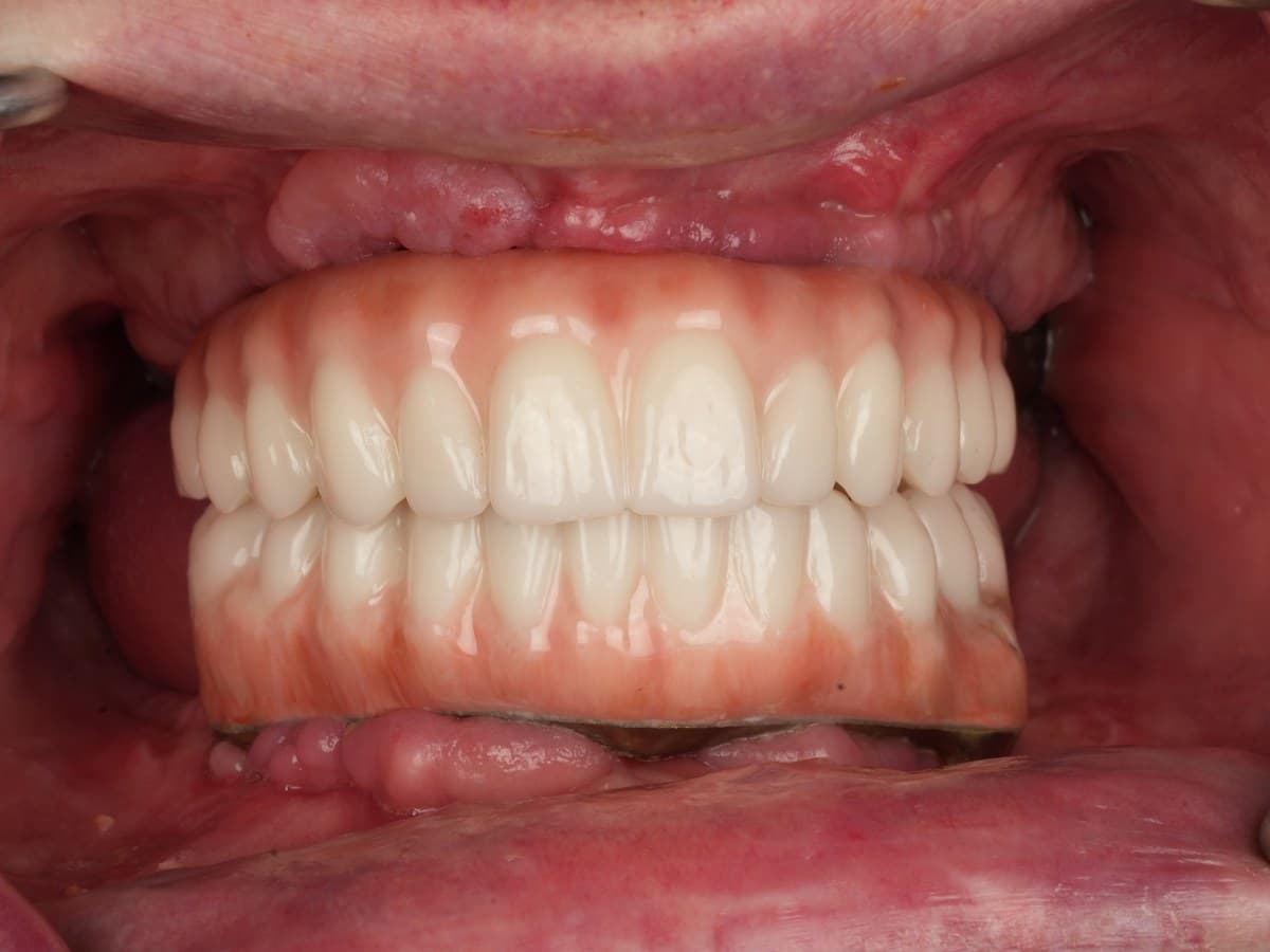 Full-arch rehabilitation, after implant placement