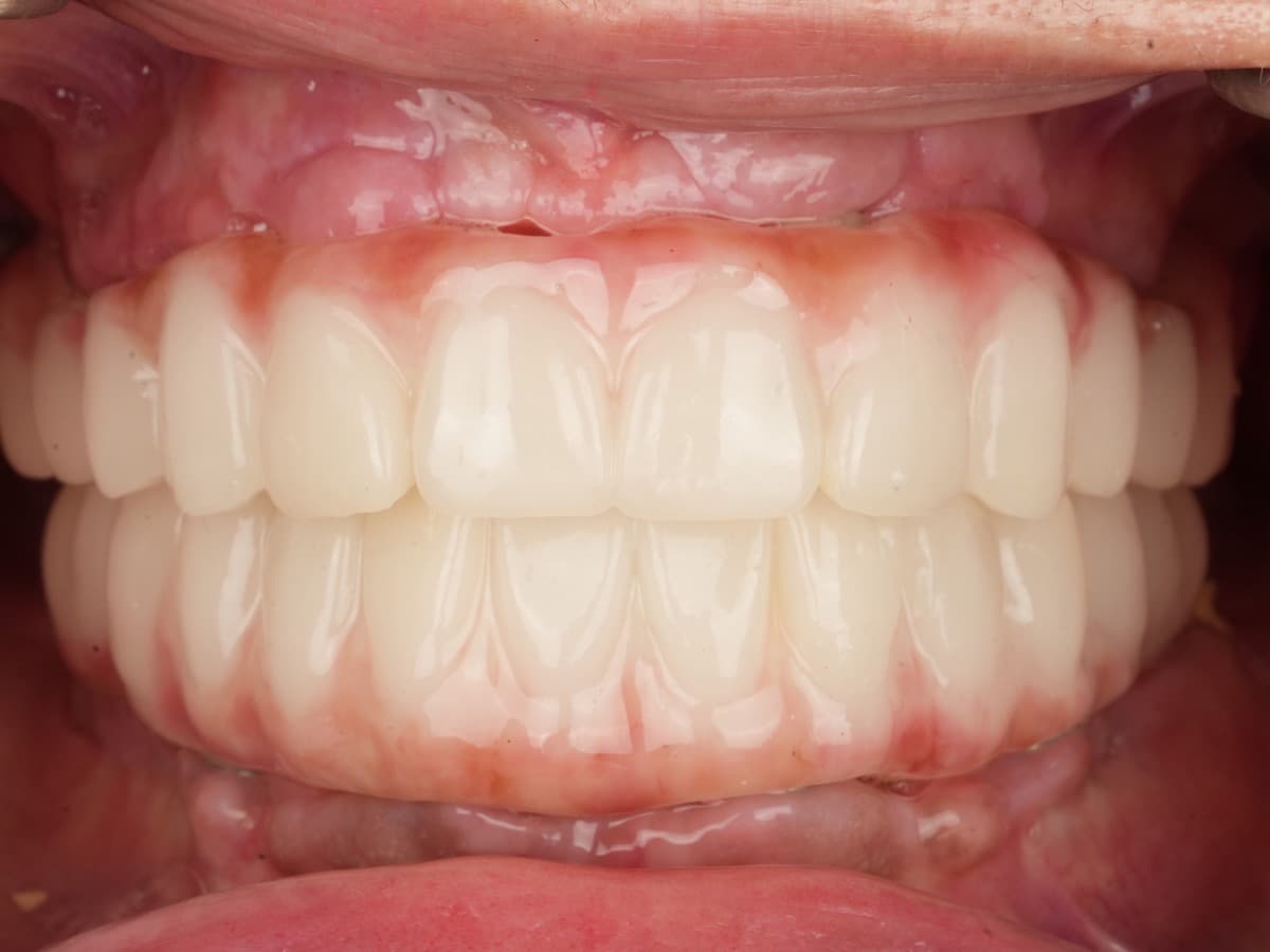 After treatment