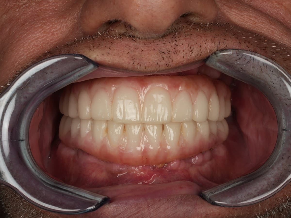 All-on-4 full-arch implant outcome