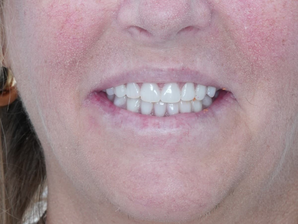 Full-arch restoration, after implant placement