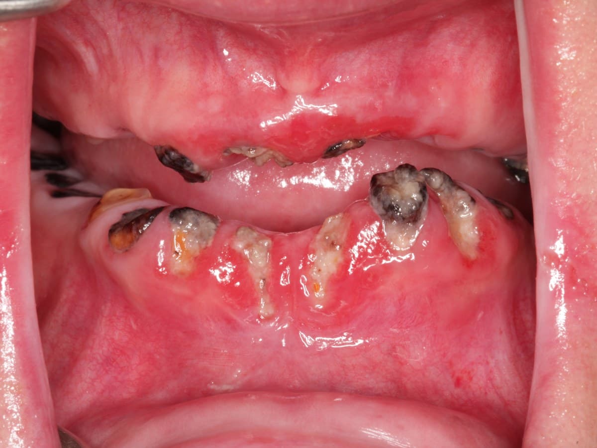 Full-arch restoration, before treatment