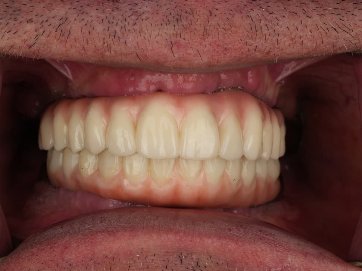 After treatment