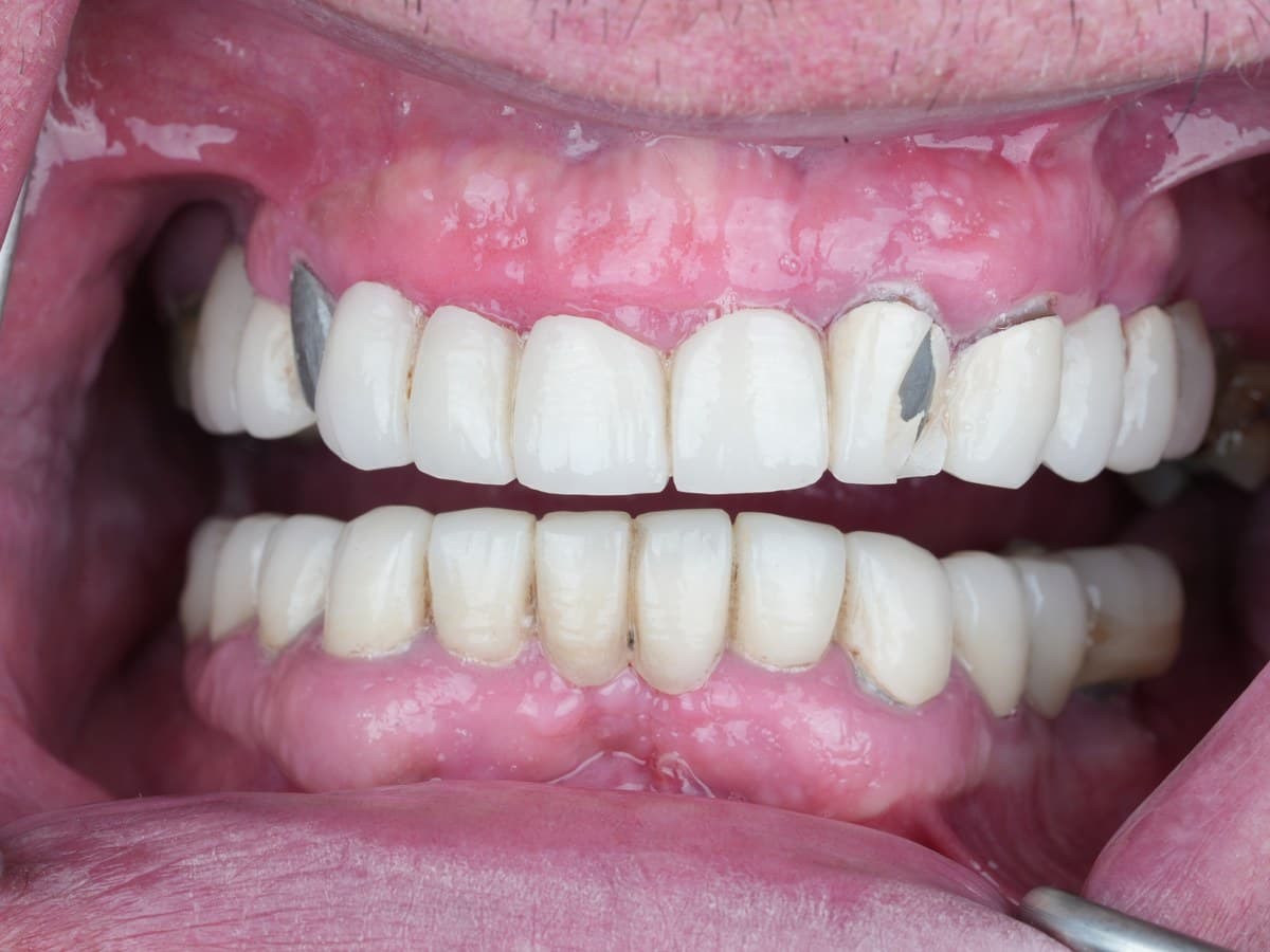 Before treatment