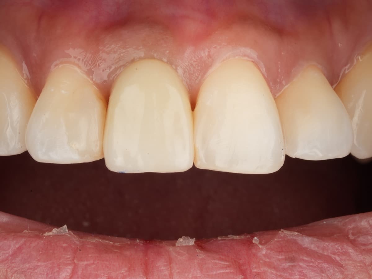 After treatment