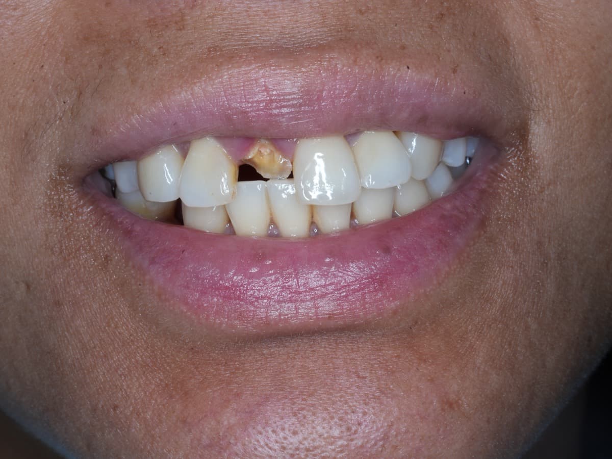 Before treatment