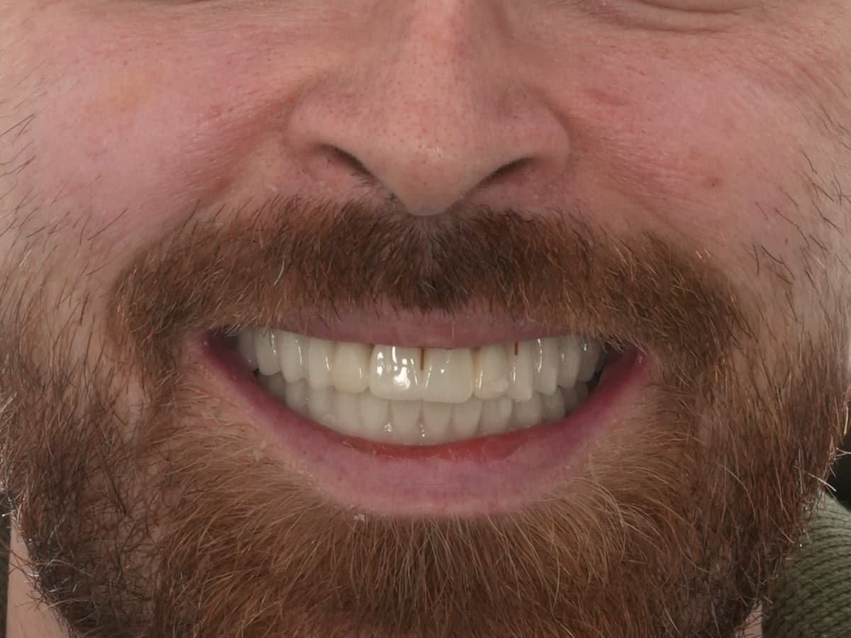 After treatment